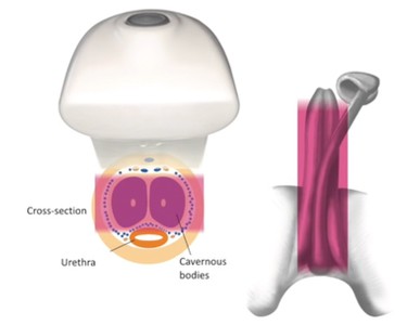 Technika wykorzystująca piezoelektryczne fale uderzeniowe skutecznie leczy zaburzenia erekcji