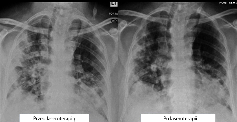 Radiograficzna ocena obrzęku płuc